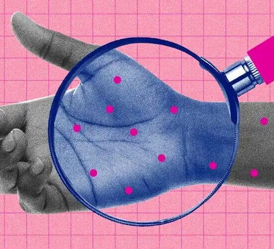 O que é Monkeypox, sintomas e como se prevenir da doença