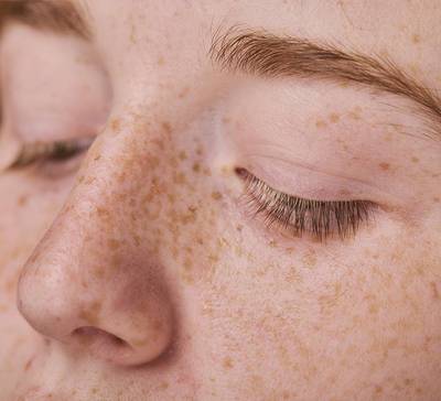 Tipos de pintas e sinais na pele: quando devo me preocupar?