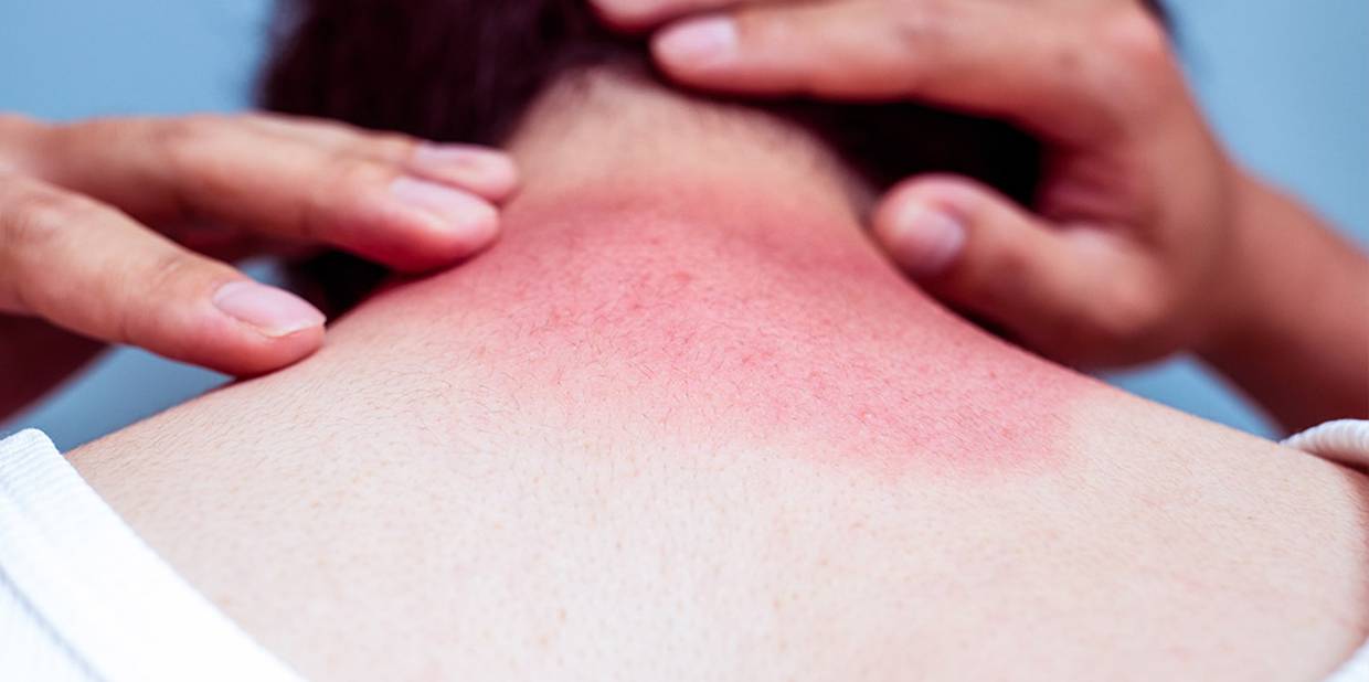 O que é bom para queimadura de sol?