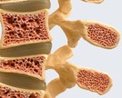 O que é osteoporose?