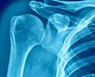 Densitometria óssea: como é feito o exame?