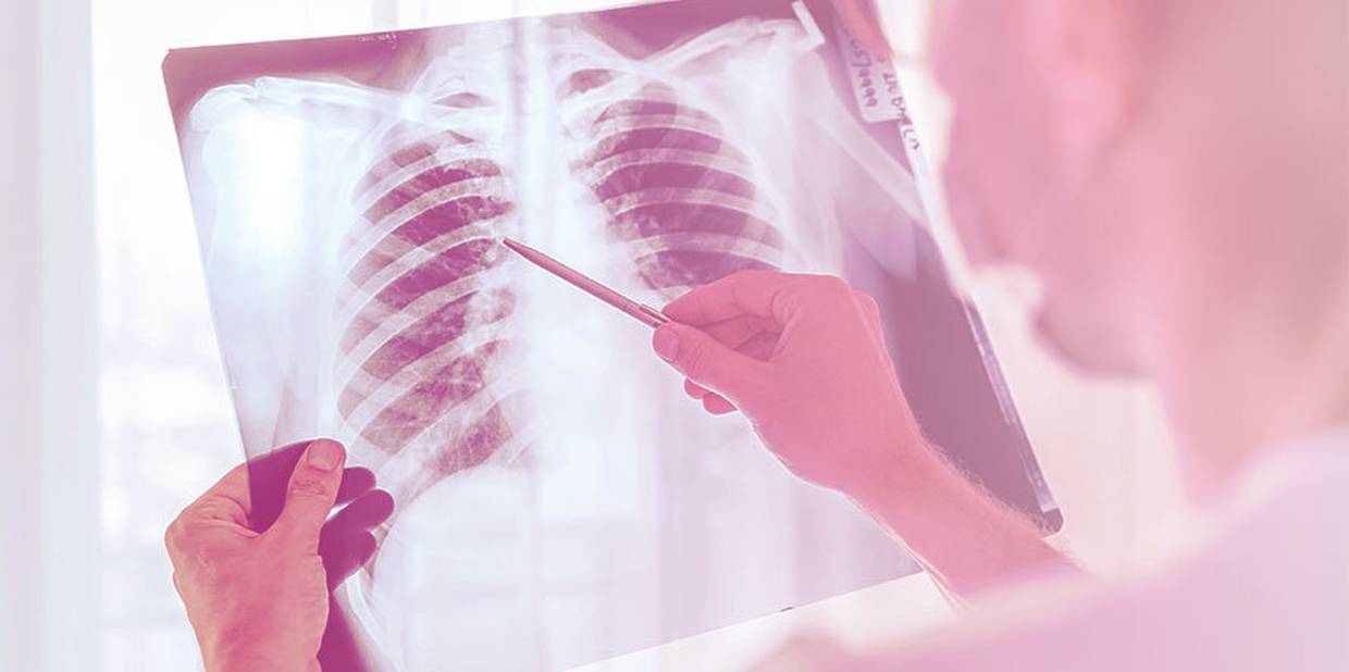 imagem de um raio x de uma costela