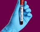 HIV: como é feito o exame?