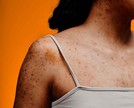 Toda pinta é cancerígena? Saiba quando se preocupar