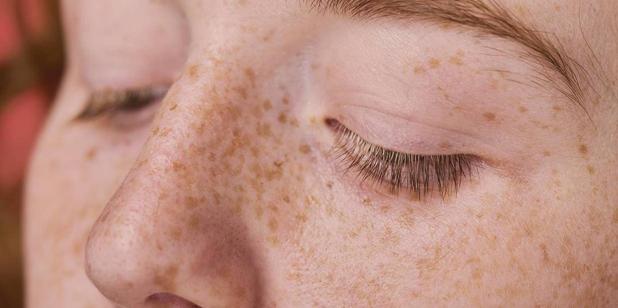 Tipos de pintas e sinais na pele: quando devo me preocupar?