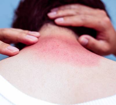 O que é bom para queimadura de sol?