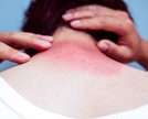 O que é bom para queimadura de sol?