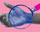 O que é Monkeypox, sintomas e como se prevenir da doença